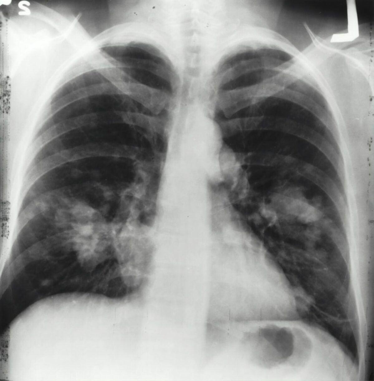  This is an x-ray image of a chest. Both sides of the lungs are visible with a growth on the left side of the lung, which could possibly be lung cancer. (Photo by National Cancer Institute via Unsplash) 