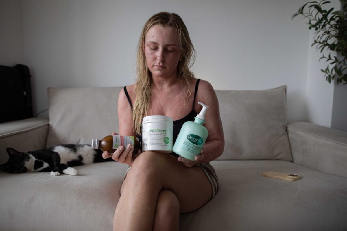  Sophie holding the creams and lotions she uses to treat her skin now. (William Lailey via SWNS) 