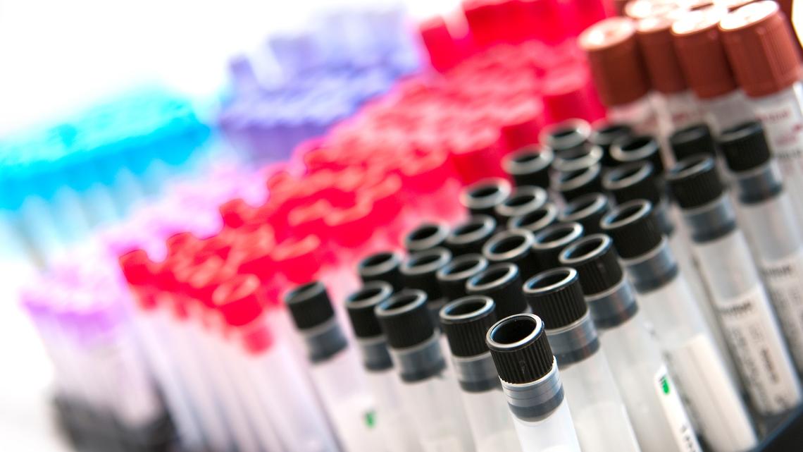 Black Americans face disproportionately high rates of kidney disease. Researchers are developing a blood test to identify those most at risk 