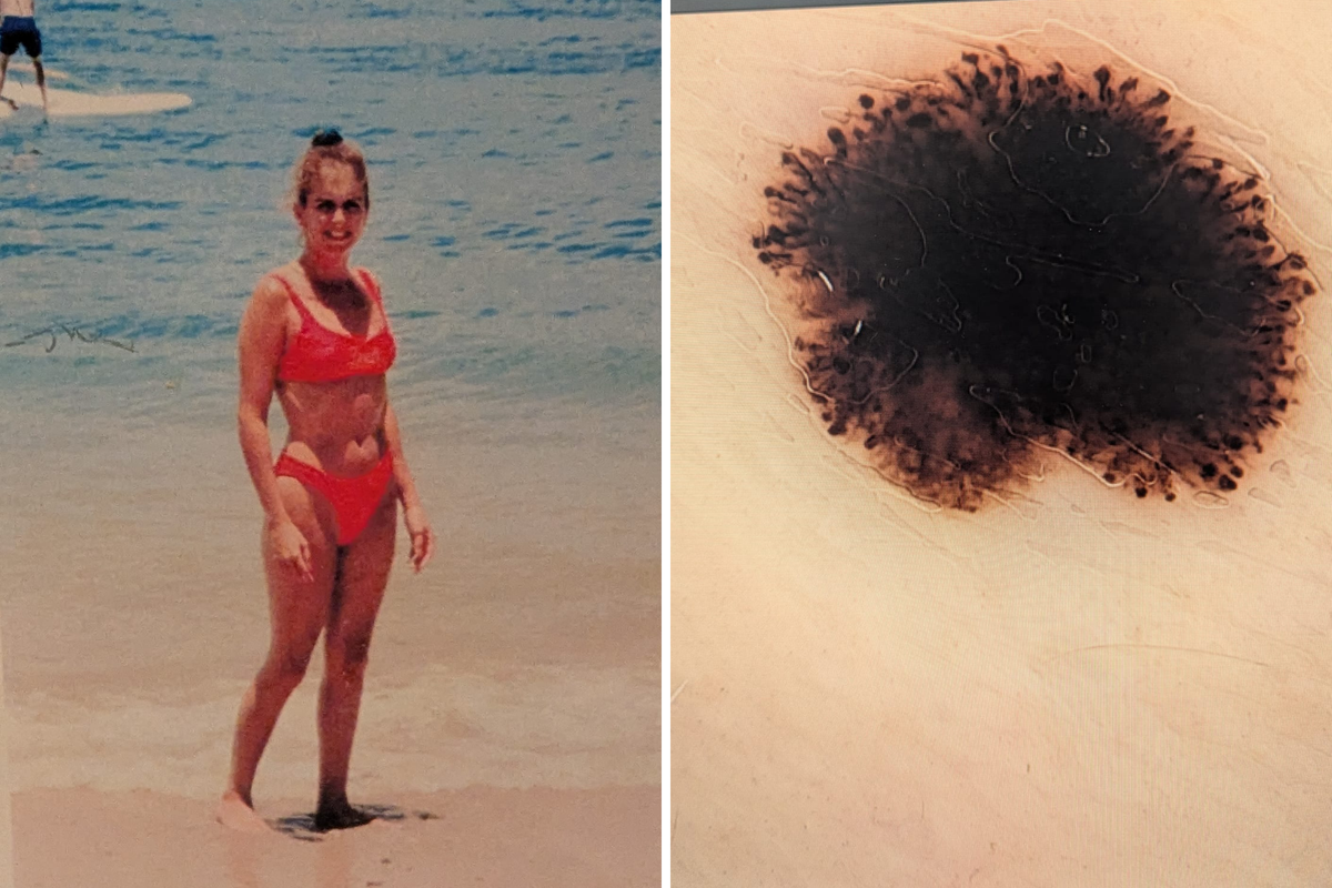  From left: Trainor wears a bikini on the beach in her teens; and the melanoma mole found on her hip is seen. 