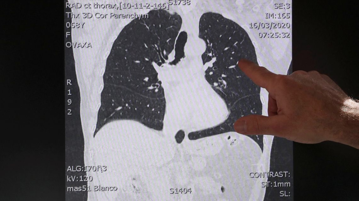 Roivant's experimental lung disease drug meets goals in mid-stage study