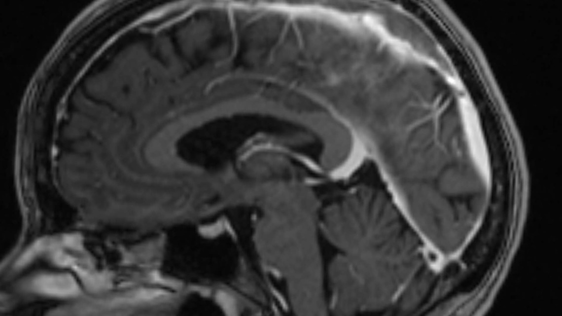 Woman's Mysterious Hallucinations Led Doctors to a Terrifying Discovery in Her Brain 