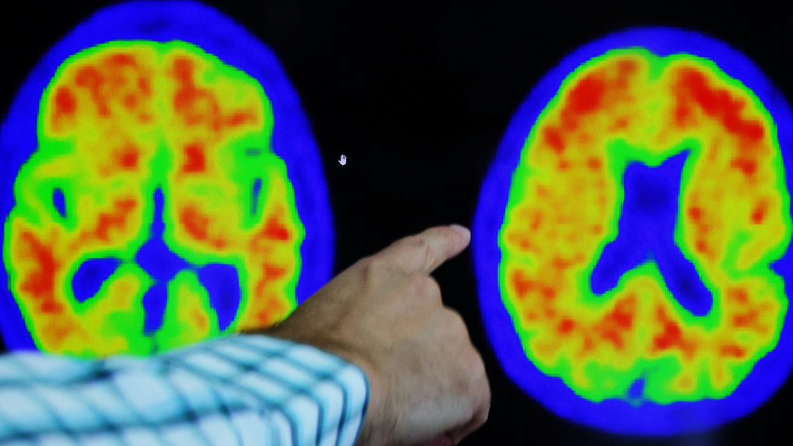 Health Rounds: Genetic discovery yields clues toward reversal of Alzheimer's brain damage