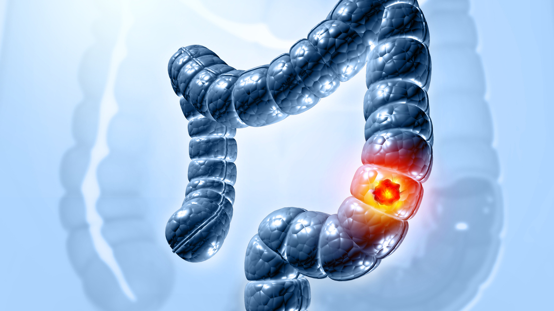 I'm a Gastroenterologist. These 3 Colon Cancer Symptoms Fool Most People 