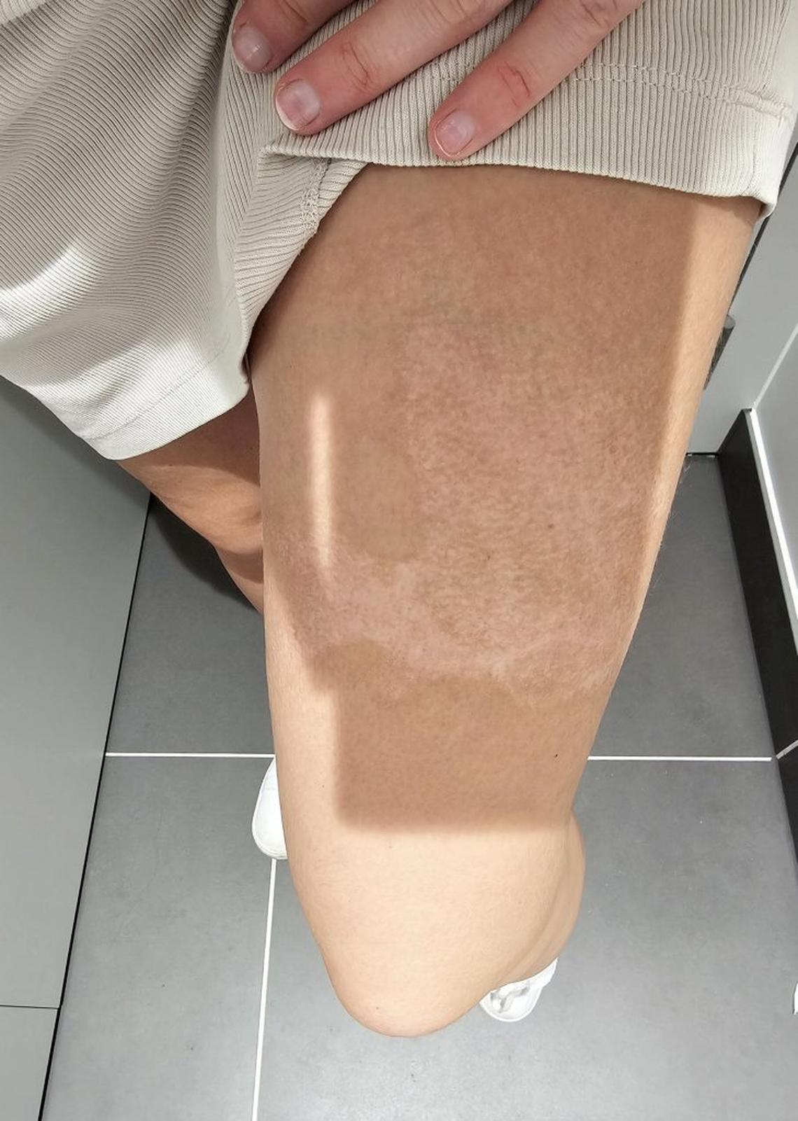  Devon Buffoni shows here scars from the hot tea burns. (Hudgell Solicitors via SWNS) 