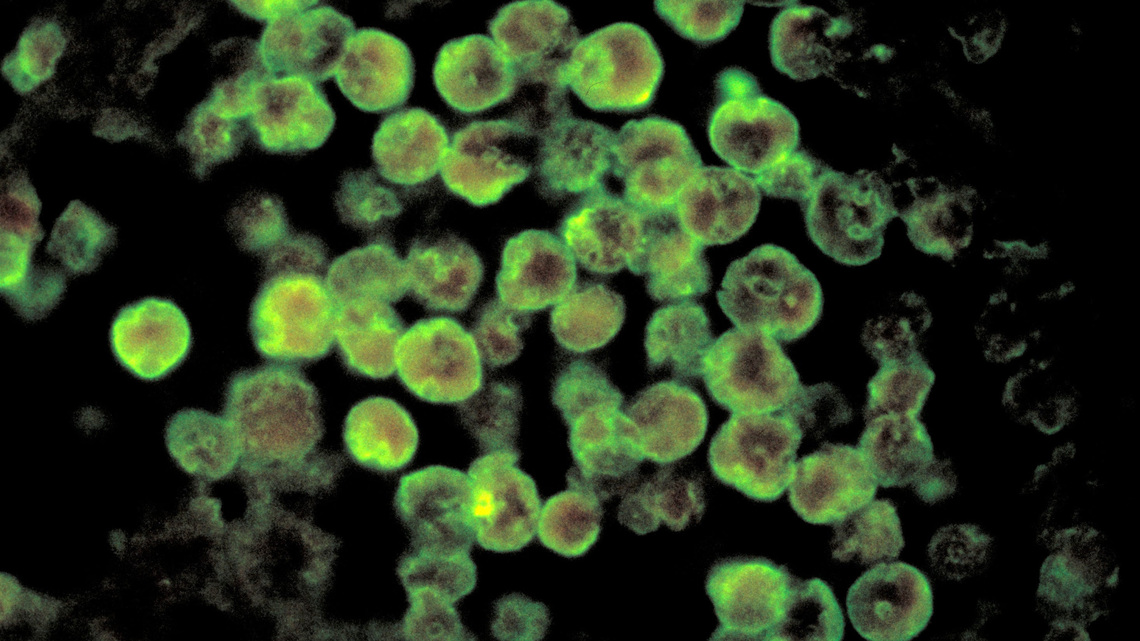 Teen in North Carolina dies after contracting brain-eating amoeba