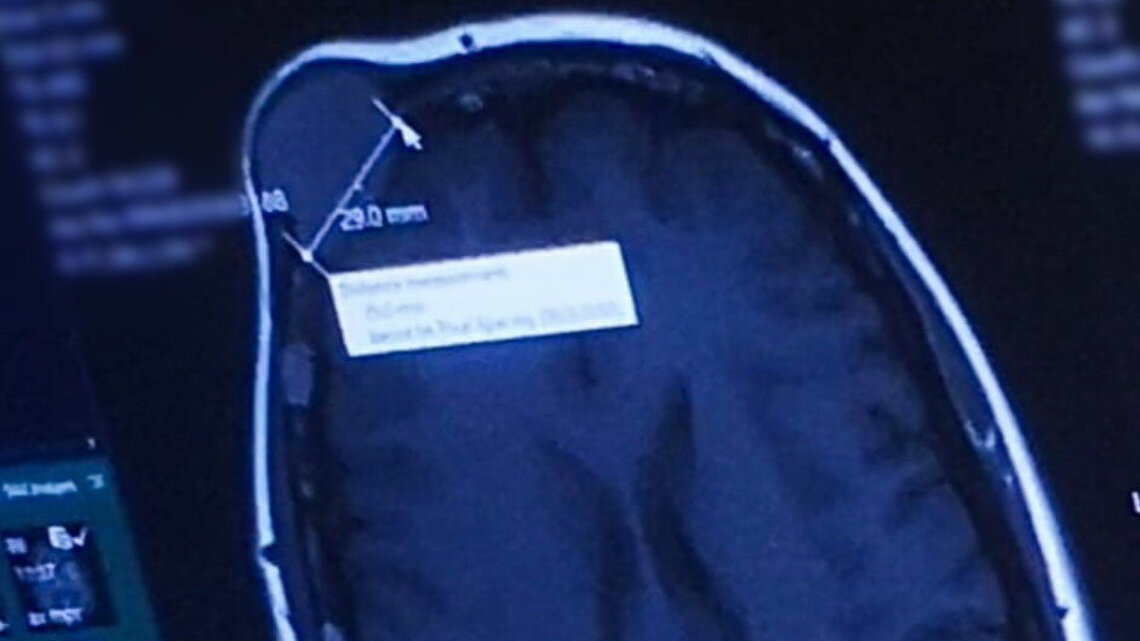 Woman's ‘harmless' head lump was cancer eating through her skull