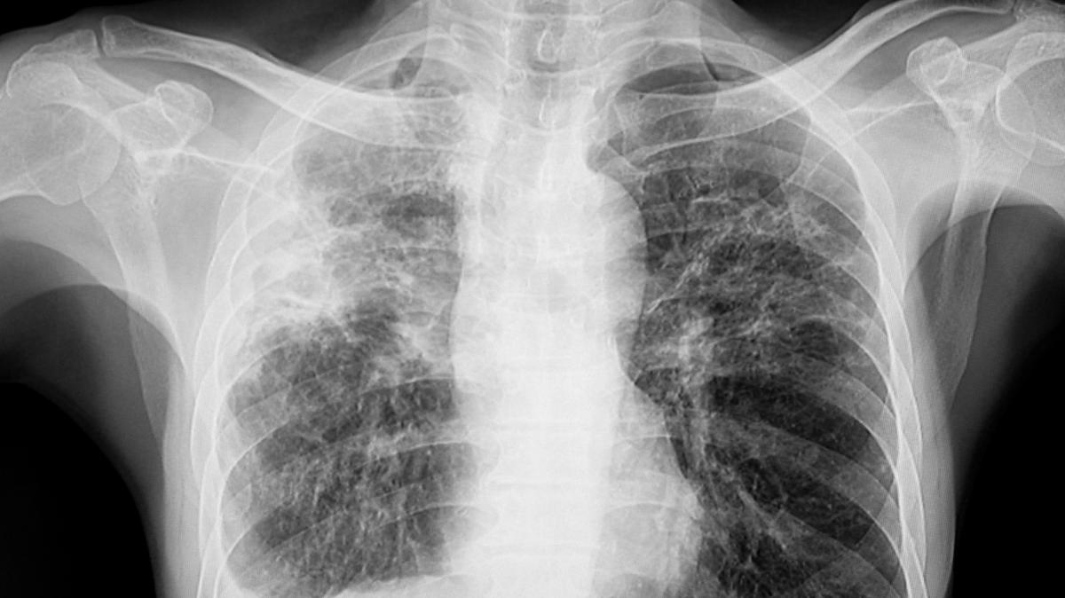 The Union County Health Department says a high school student has tested positive for tuberculosis and that at least 270 people were exposed. This 2021 photo shows a chest x-ray of a person’s lungs who has tuberculosis.