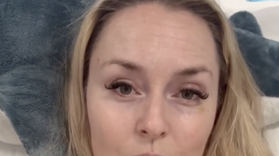 Lindsey Vonn Reveals How Many More Surgeries She Needs After Olympic Crash 