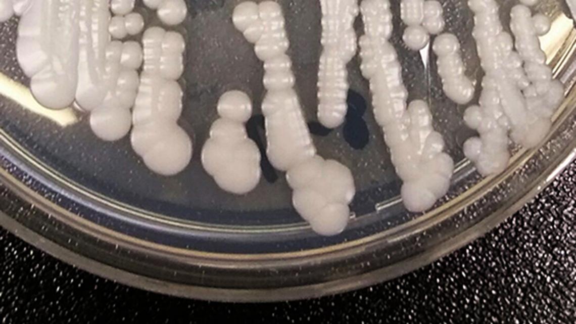 Cases of dangerous ‘superbug’ reported in KY, other states. What one hospital is doing