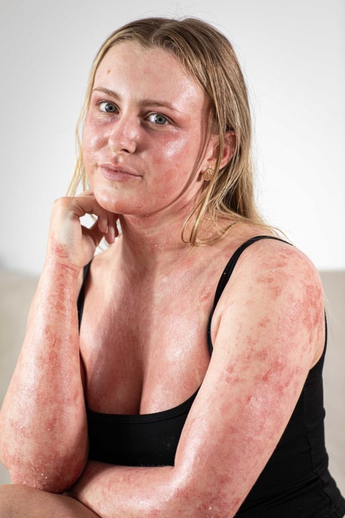  Sophie Cooper said she suffered from eczema as a child, but it got worse in 2023. (William Lailey via SWNS) 
