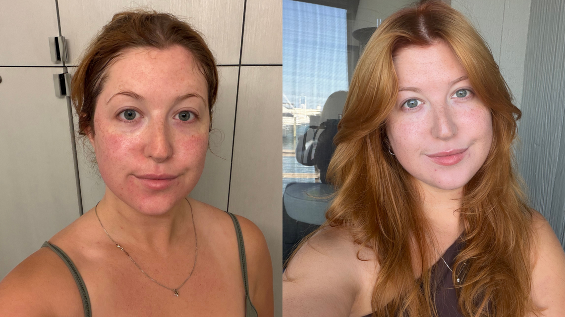 I Tried the Viral K-Beauty Cream After a Laser Facial - See My Results 