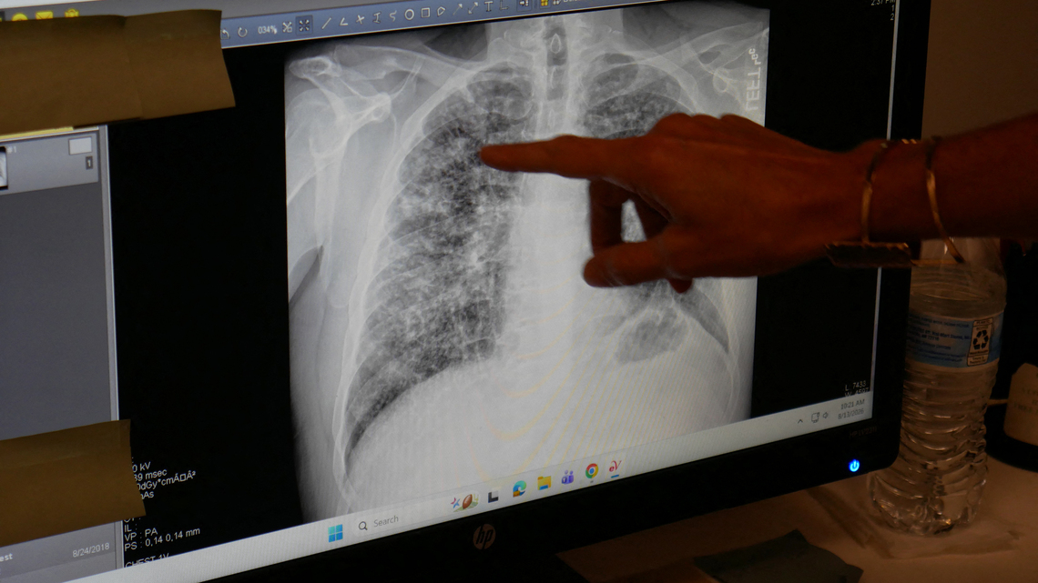 Mark Gongloff: Black lung disease is the only true comeback for coal