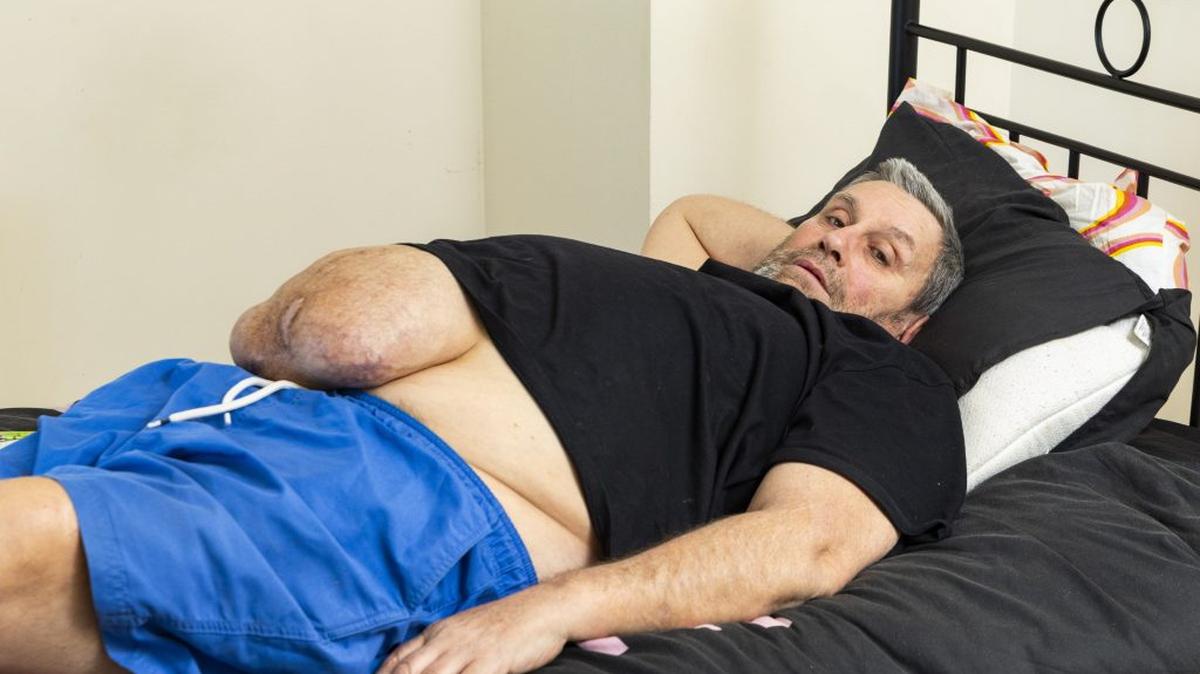 John Burden has a watermelon-sized hernia. (Tom Wren via SWNS). 