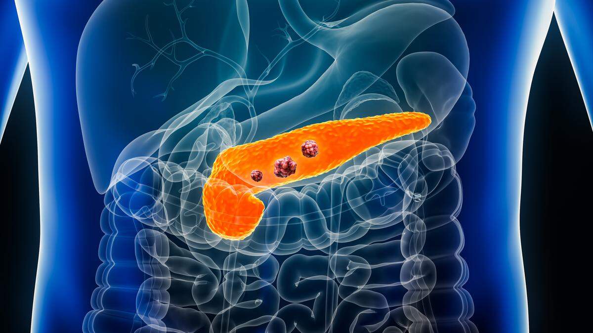 Pancreatic cancer is one of the most dire diagnoses in medicine. There are few available treatments, and they do little to help.