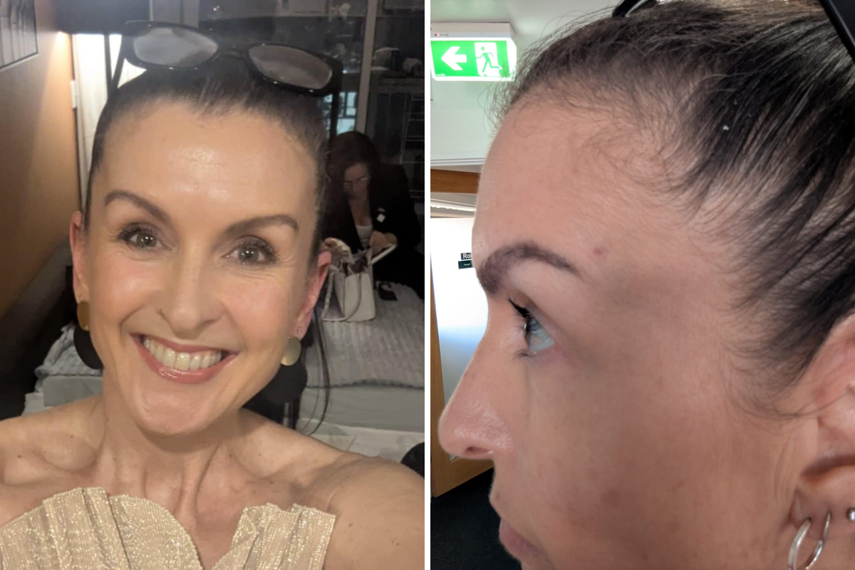  From left: Simone Trainor smiles for the camera; and shows her side‑profile to highlight the spot above her eyebrow. 