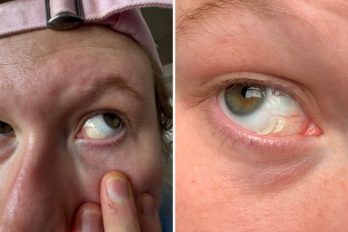  Alabama Jackson’s left eye after the blister returned. 