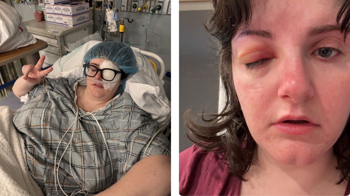 Carissa Mosness after her fourth eye surgeryCarissa Mosness