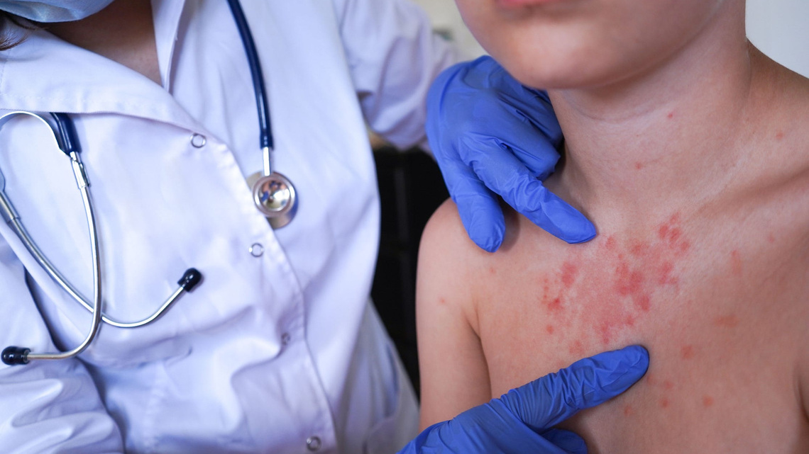 Kentucky has largest measles outbreak since the 90s, officials say 