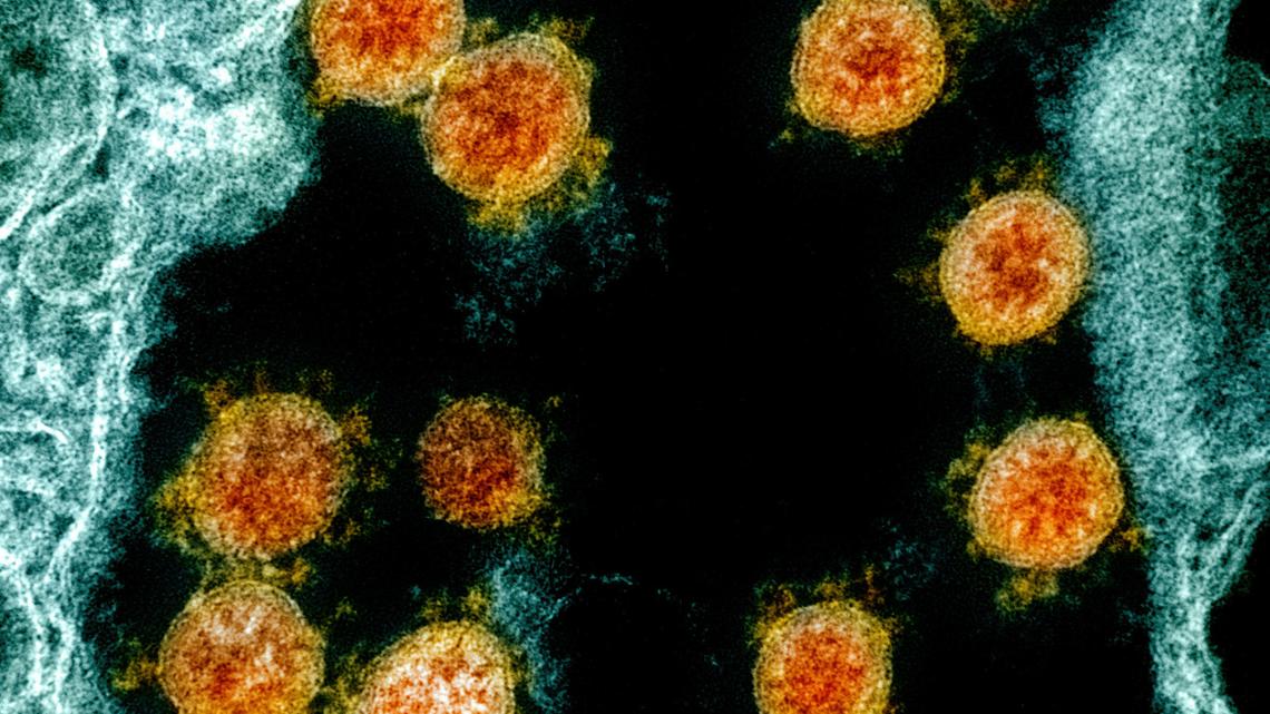 This electron microscope image made available and color-enhanced by the National Institute of Allergy and Infectious Diseases Integrated Research Facility in Fort Detrick, Md., shows Novel Coronavirus SARS-CoV-2 virus particles, orange, isolated from a patient.
