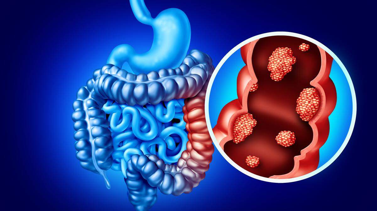 Among people 65 and older, colorectal cancer rates have been steadily declining since the mid-1980s. By contrast, studies in recent years have shown colorectal cancer rates on the rise among adults younger than 50.