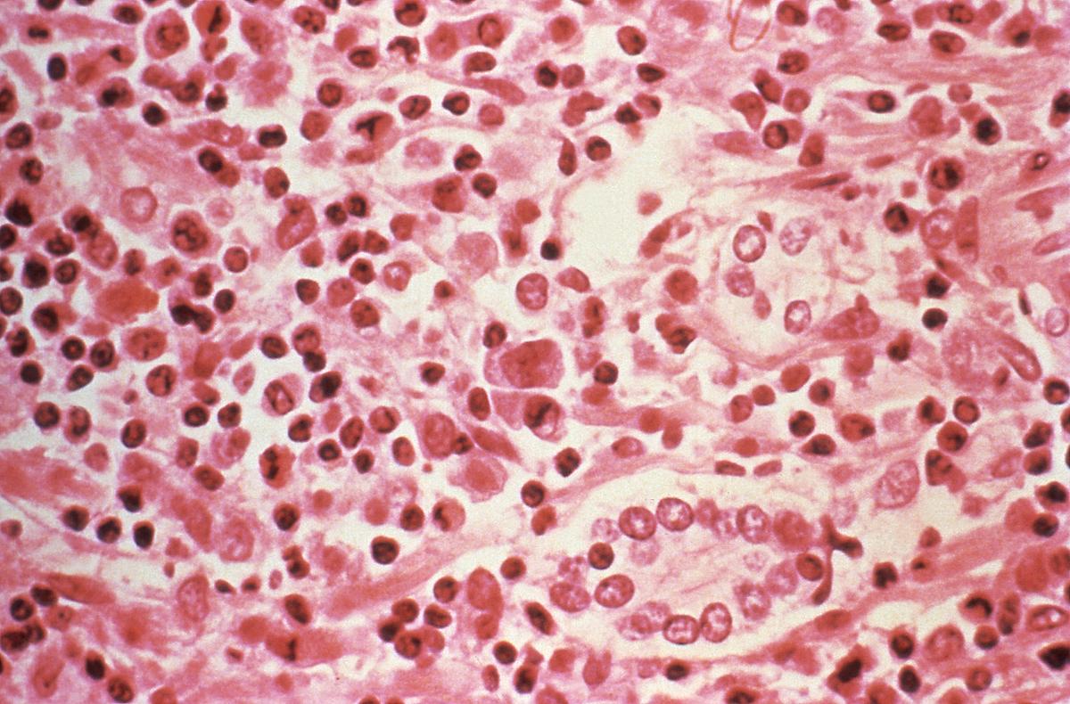 FILE PHOTO: A micrographic study of liver tissue seen from a Hantavirus pulmonary syndrome (HPS) patient seen in this undated photo obtained by Reuters, July 6, 2017. Centers for Disease Control and Prevention/Handout via REUTERS /File Photo