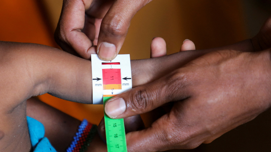 Somali child hunger crisis deepens as facilities close due to aid cuts, UNICEF says 