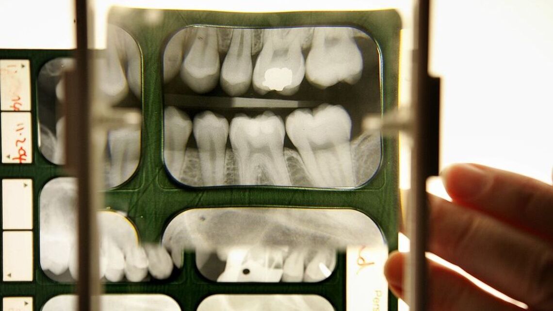 Anti-Aging Drugs Reversed Tooth Decay and Wisdom Teeth Were the Key 