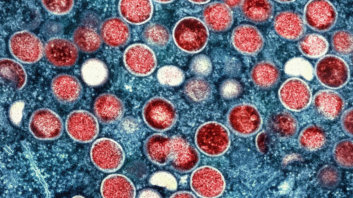 This image provided by the National Institute of Allergy and Infectious Diseases shows a colorized transmission electron micrograph of monkeypox particles, colored red, found in an infected cell, colored blue.