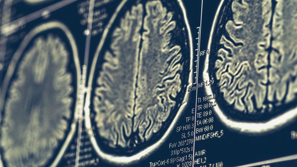 In some cases, less invasive treatments may be an option for brain tumor treatment. (Dreamstime/TNS)