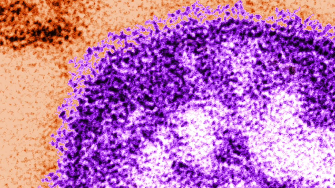 Another Pennsylvanian has died from measles-related complications, officials say 