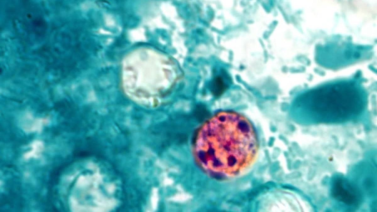 Cyclospora has surged in many U.S. states including Kentucky as of July 10, 2026.