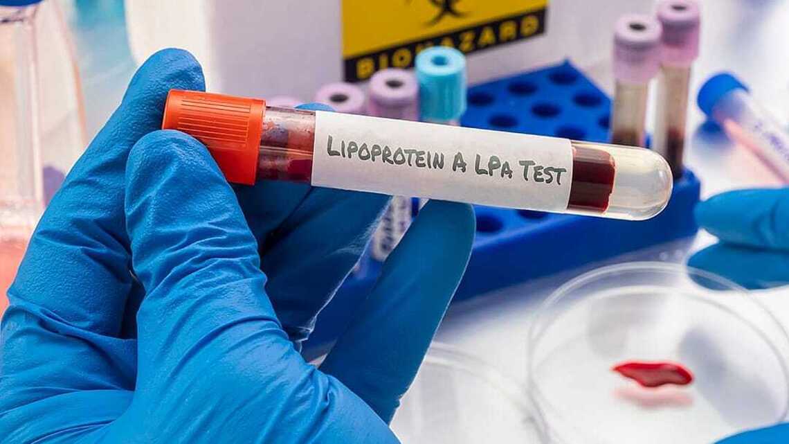 1 in 5 people may have this hidden genetic stroke risk 
