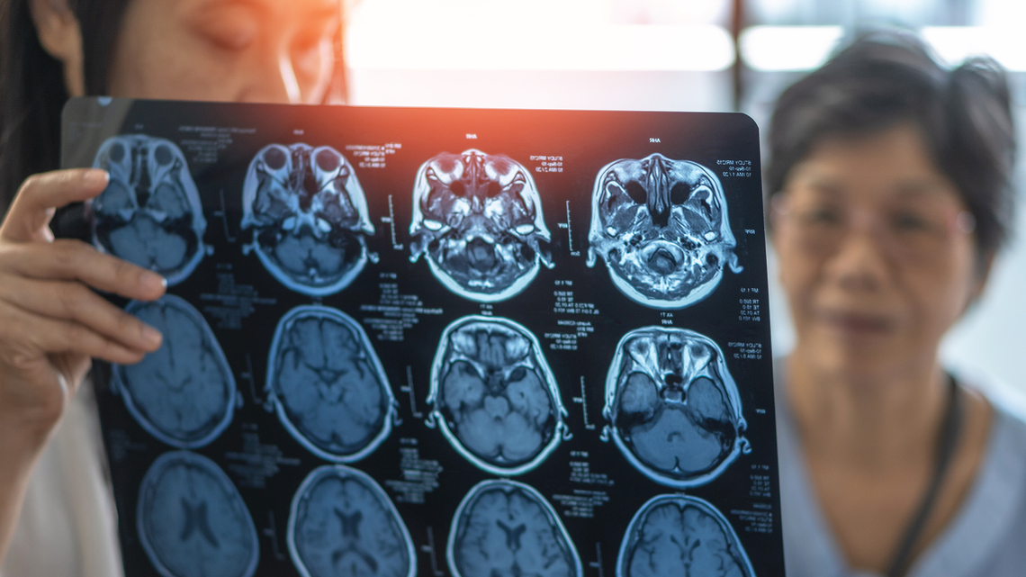 Estrogen Therapy May Hold Clues to Lower Dementia Risk in Women