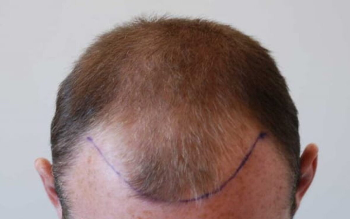  Wayne Rooney before his hair transplant. (Harley Street Hair Clinic via SWNS) 