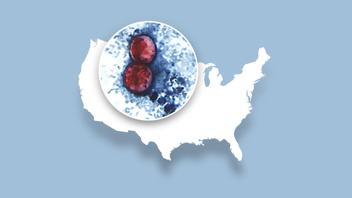 Latest updated map tracking 'explosive diarrhea' cases in the US 