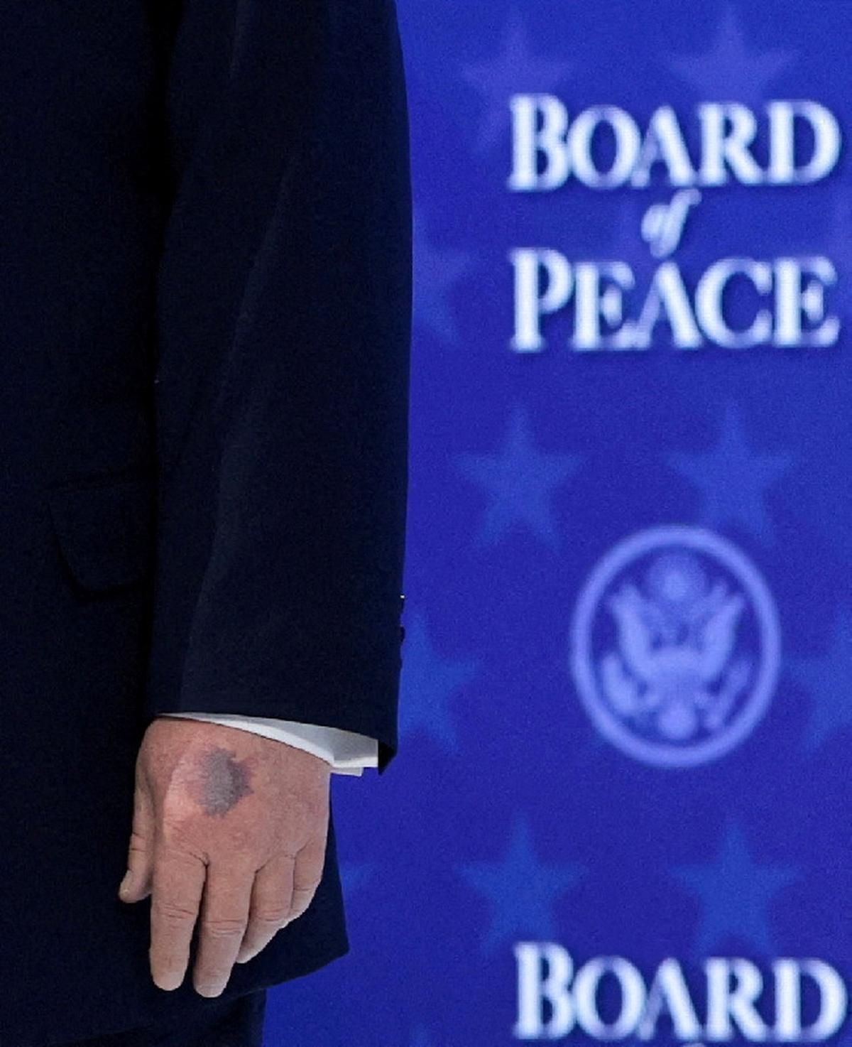 FILE PHOTO: U.S. President Donald Trump's bruised hand, as he attends a charter announcement for his Board of Peace initiative aimed at resolving global conflicts, alongside the 56th annual World Economic Forum (WEF), in Davos, Switzerland, January 22, 2026. REUTERS/Jonathan Ernst/File Photo