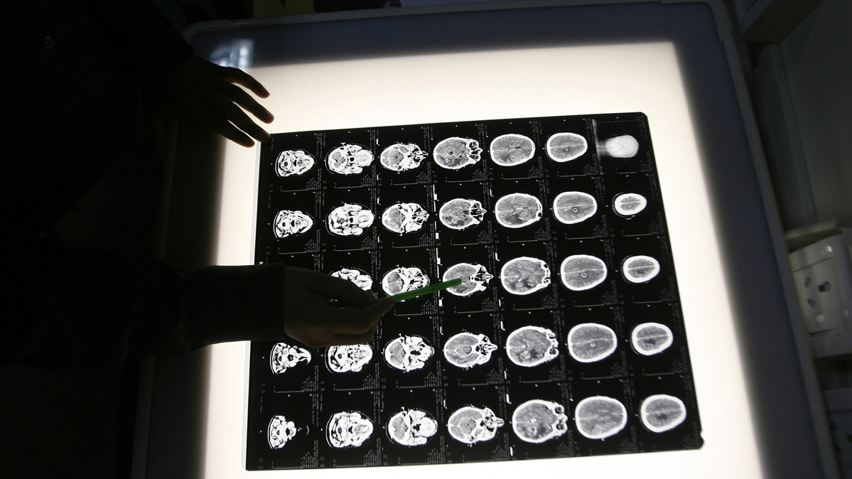 FILE PHOTO: A radiologist examines the brain X-rays of a patient who underwent a cancer prevention medical check-up at the North Bengal Oncology Center, a cancer hospital, on the outskirts of the eastern Indian city of Siliguri February 25, 2009. REUTERS/Rupak De Chowdhuri (INDIA)/ File Photo