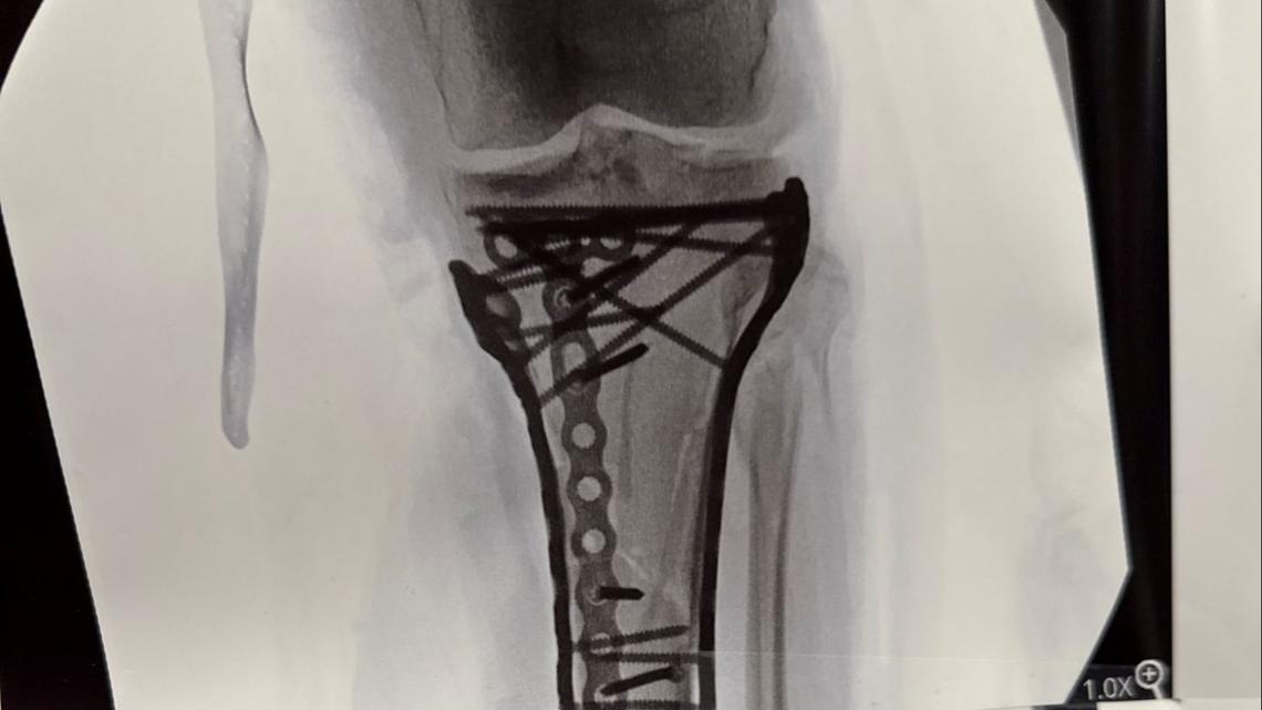 Lindsey Vonn Shares Graphic X-Ray of Broken Leg After 2026 Olympics Injury 